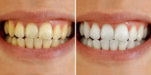 Bút  tẩy trắng răng Dazzling White giúp răng trắng sáng 3-4 tông so với ban đầu (*)