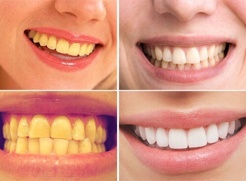 Hàm răng hết ố, trắng sáng nhanh chóng chỉ sau một thời ngắn dùng Eucryl Toothpaste 