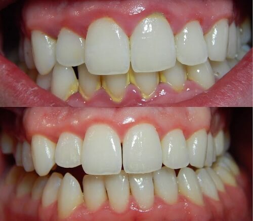 Mảng bám, cao răng sẽ được loại bỏ dễ dàng hơn chỉ sau vài ngày sử dụng nước súc miệng Propolinse
